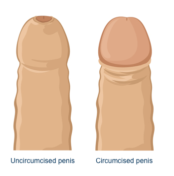 An image showing the appearance of a circumcised and uncircumcised penis.