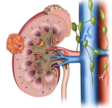 Image showing a small cancer in the kidney