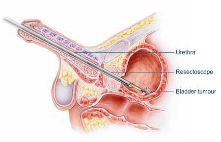 Image showing the removal of a bladder tumour during a TURBT. A resectoscope is passed via the urethra into the bladder to remove the tumour. 