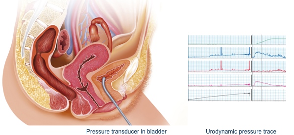 Image showing catheter in the bladder measuring pressure and a urodynamic pressure trace.