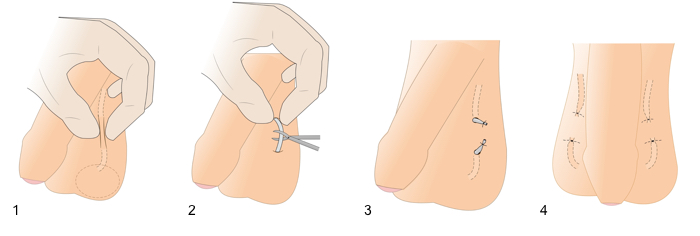 An image showing how a vasectomy is performed. 